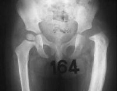 Fifth radiograph in series of septic left hip. Fiv
