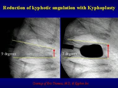 Reduction in kyphotic angulation after kyphoplasty