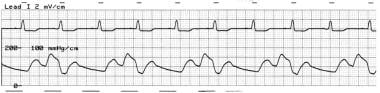 Intra-aortic balloon pressure tracing depicting th