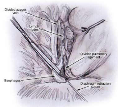 Minimally invasive esophagectomy. Mobilization of 