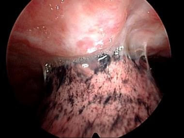 Pleural adhesions on medical thoracoscopy. 