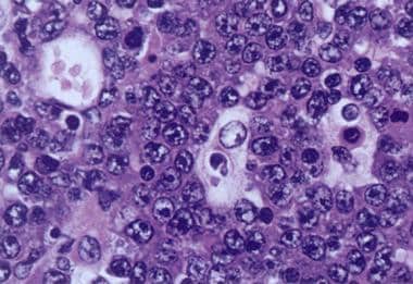 Burkitt lymphoma cells with round noncleaved nucle