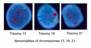 Abnormalities of chromosomes 13, 18, and 21. 