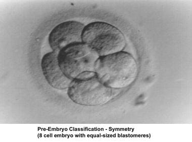 Infertility. Preembryo classification - Symmetry (