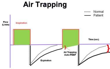 Mechanical Ventilation: Background, Classifications of 