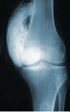 Extensive heterotopic ossification at the medial a