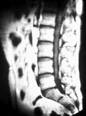 Sagittal T1-weighted MRI of the lumbar spine in a 