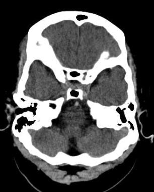 基底动脉致密:轴位CT平扫显示
