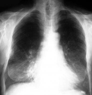 Chest radiograph in a 62-year-old patient with NF1
