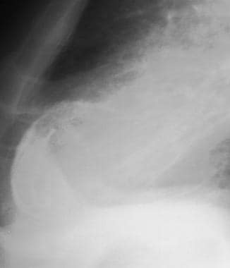 Lateral chest radiograph from the patient shown in
