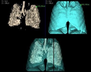 CT densitovolumetry in a heavy smoker with emphyse