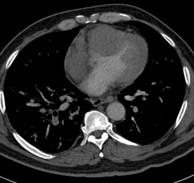 Lung Metastases Imaging: Overview, Radiography, Computed Tomography