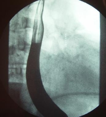 Barium esophagogram demonstrating gastroesophageal