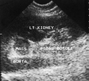 Ultrasonogram of an adrenal mass. Oblique sagittal