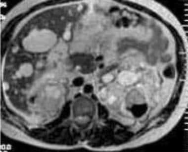 Case 19. Left renal cell carcinoma in a patient wi
