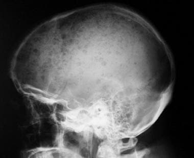 Lateral radiograph of the skull. This image demons