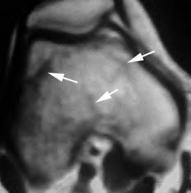 Axial T1-weighted MRI of the knee in a patient wit