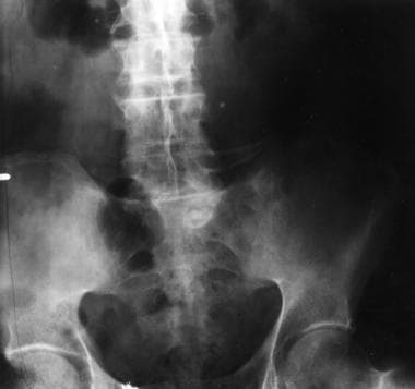 Anteroposterior radiograph of the abdomen shows fu