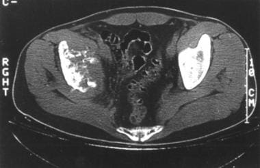 A 65-year-old man with right hip pain. Axial compu