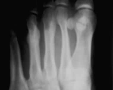 Fractured metatarsals. Image shows a stress fractu