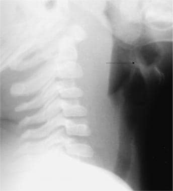 Image shows a normal epiglottis in a child; howeve