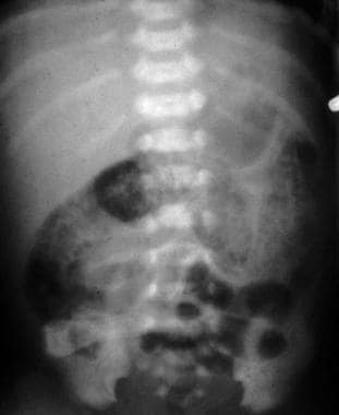 Anteroposterior image shows necrotizing enterocoli