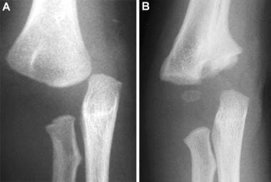 Transphyseal fracture. (A) Initial anteroposterior