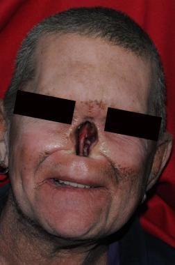 Patient with well-healed total rhinectomy defect. 