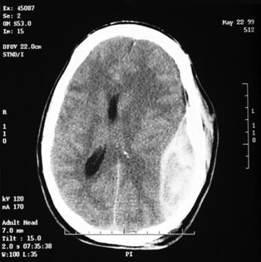 The head CT scan for trauma identifies space-occup