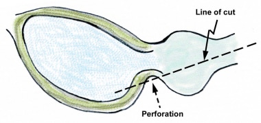 Perforation at the inferior bladder neck can easil