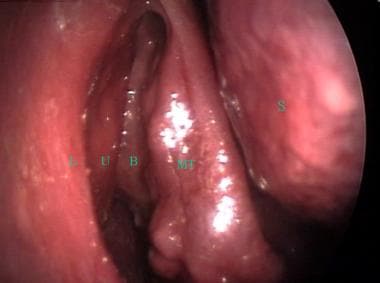 Maxillary sinusitis deals symptoms