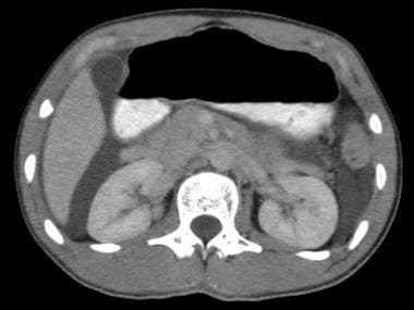 CT demonstrates free intraperitoneal fluid due to 
