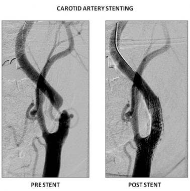 Images show vessel before and after carotid artery
