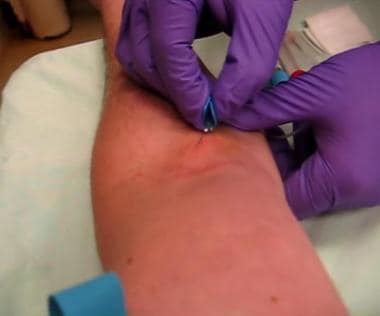 Phlebotomy. Insertion of winged butterfly device.