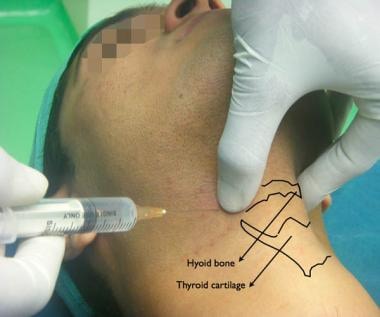 Superior laryngeal nerve block. The hyoid bone is 