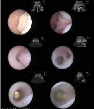 Fetoscopic images of landmarks during percutaneous