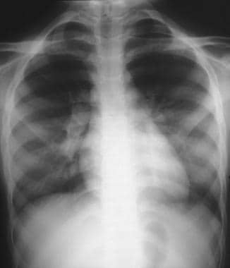 Chest radiograph showing bilateral hilar lymphaden