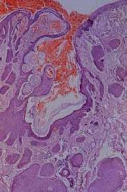 Low-power view of trichofolliculoma with a primary