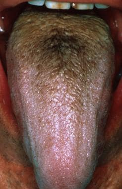 Brown hairy tongue in a middle-aged man who smokes