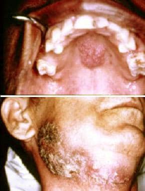 blastomycosis oral lesions