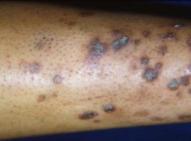 Lesions on the shin of a patient who is HIV negati
