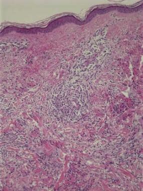 Low-power view of leukemia cutis acute myeloblasti