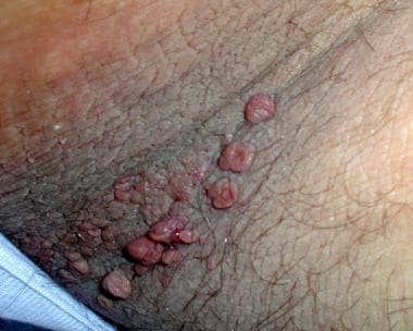 Brown velvety plaques with skin tags in the axilla