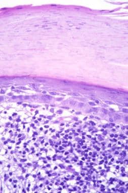 Hematoxylin and eosin-stained section, high magnif