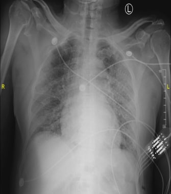 The trachea is in midline. The cardiomediastinal s