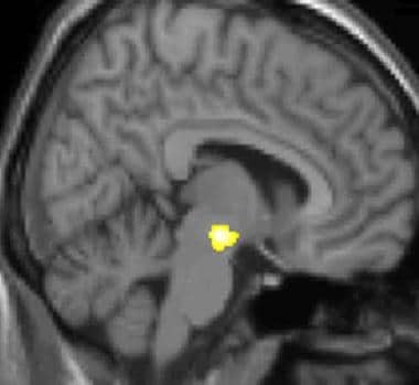 Cluster headache (CH): Voxel-based morphometry (VB