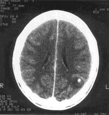 Computed tomographic (CT) scan of the brain in a p
