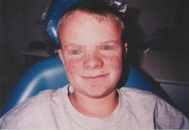 Facial angiofibromas in a young man with tuberous 