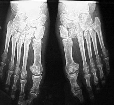 Radiograph illustrating diabetic patient with firs