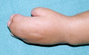 Dorsal view of hand of 6-month-old patient with ty